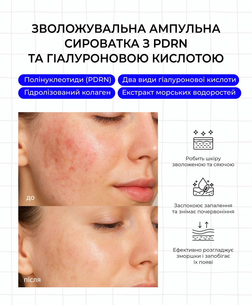     PDRN   , 30 